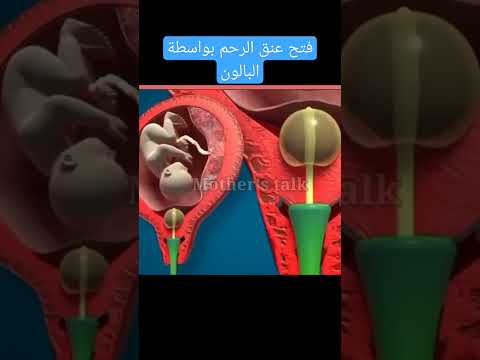 فتح عنق الرحم بواسط البالون