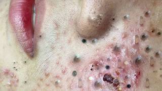 Satisfying Acne Removal for Clear Skin Transformation