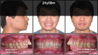 Solving Excessive Overjet with Invisalign and OBS｜【Chris Chang Ortho】CC648