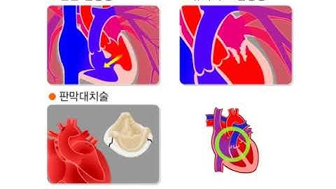 감염성 심내막염에 대한 예방조치