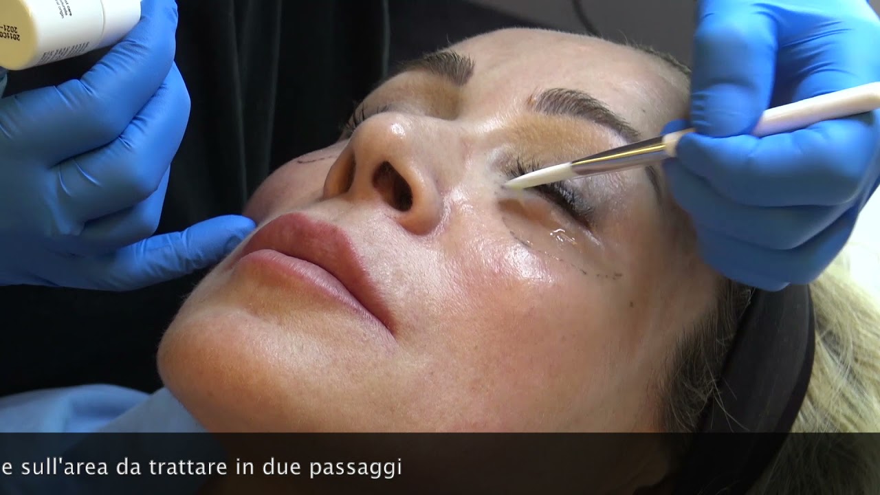 Il trattamento con Topilase: la ialuronidasi topica corregge gli effetti indesiderati da filler