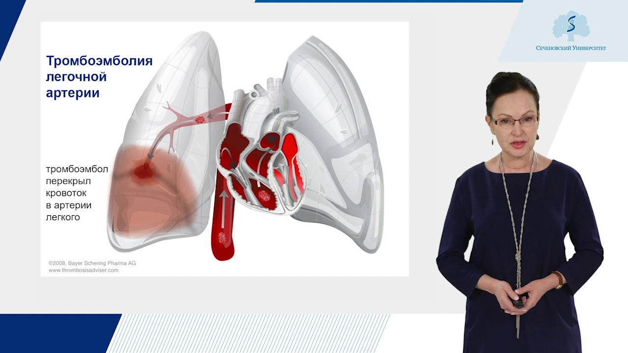 Что такое легочная тромбоэмболия простыми словами. Тромбоэмболия лёгочной артерии: этиология, клиническая картина.. Эмболия легочной артерии. Омбоэмболия лёгочной артерии. Тромбоэмболия легочной артерии фото.