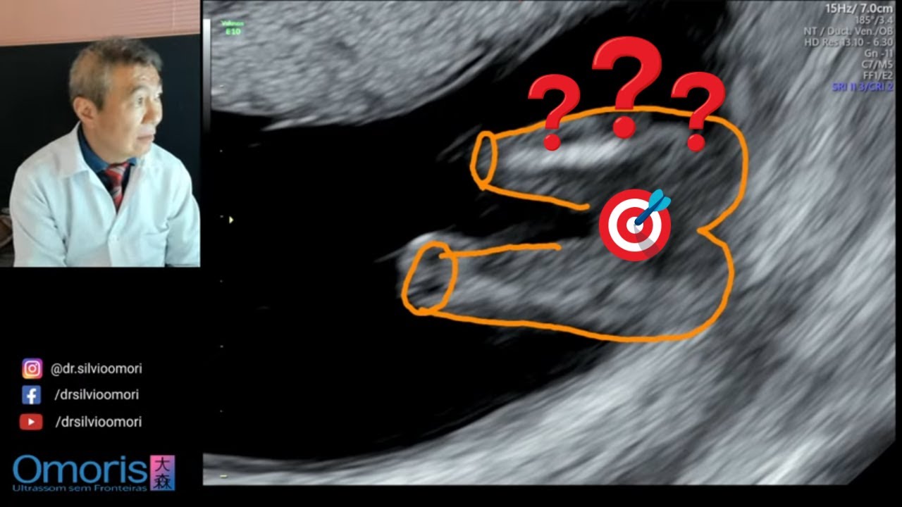 Девочка или мальчик? Беременность 13 недель.