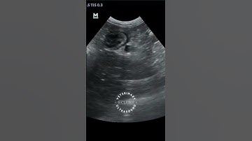 Gallbladder and dilated duct followed up to the duodenal papilla