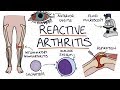 Reaktive Arthritis Verstehen