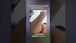 Pelos Indesejados Do Minoxidil