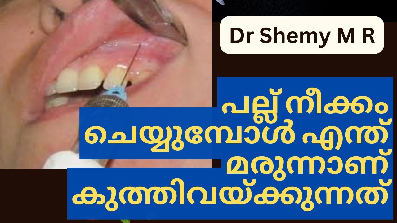Teeth Remove Injection Why an INJECTION during TEETH REMOVAL? കുത്തിവെക്കുന്നത് എന്തിന്? Local ...