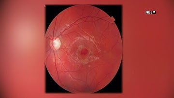 Laser pointer danger