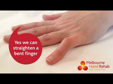 Yes, We Can Straighten Your Bent Finger!