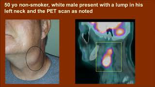 HPV and Oropharynx Part 2 Information