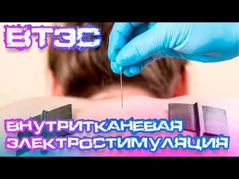 Метод ВТЭС: преимущества и принцип действия | Эффективность лечения с доктором Белозёровой М.А.