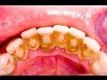 HOW TO REMOVE DENTAL PLAQUE IN 5 MINUTES NATURALLY WITHOUT GOING TO THE DENTIST