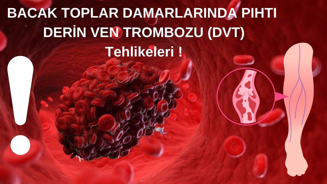 Toplardamar Pıhtılaşması Tehlikeli Mi ?  | Derin Ven Trombozu | DVT | | Op.Dr. Aybanu Gökçen