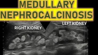 Bilateral Medullary Nephrocalcinosis On Usg And Its Causes