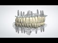 3shape design full arch diagnosis implant case