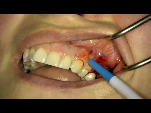 Vidéo: Traitement D'un Kyste Dentaire Sans Extraction: Options Possibles