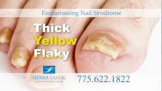 Sierra Tahoe Wellness Center_Laser Nail Treatment_2012