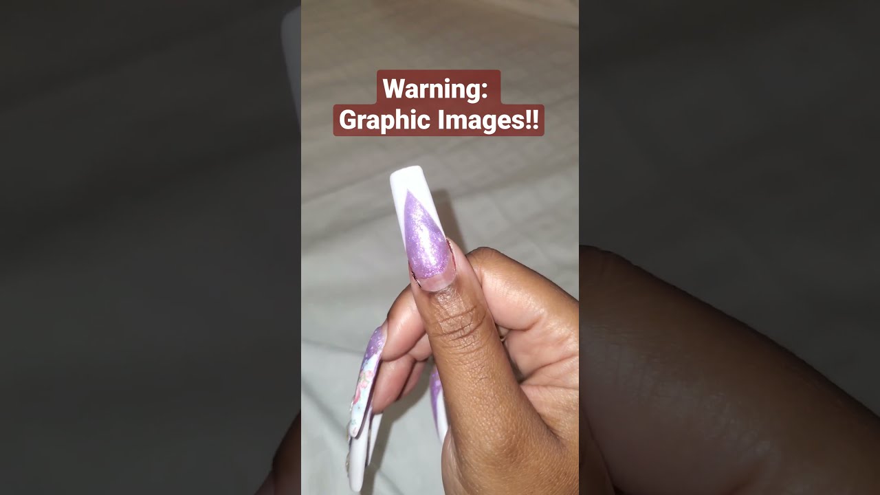 Will my thumb nail fall off? 😳 shorts YouTube