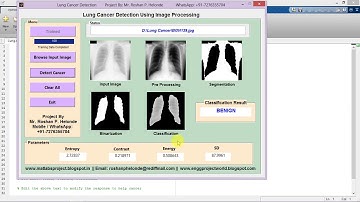 Lung Cancer Detection using Image Processing Matlab Project with Source Code