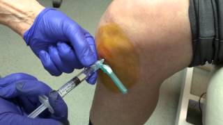 Norwich Podiatrist - Ostenil Plus injection of the knee - part 2