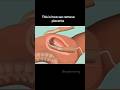 How to remove placenta by hand #3danimation #medicalshorts #pregnancy #pregnancyjourney