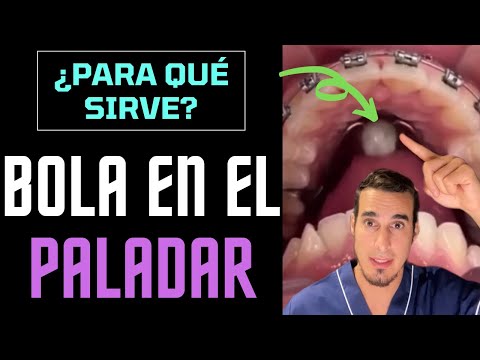 Vídeo: Què és parl a dental?