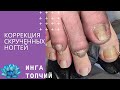 Вросший ноготь!!! Коррекция скрученных ногтей!!!