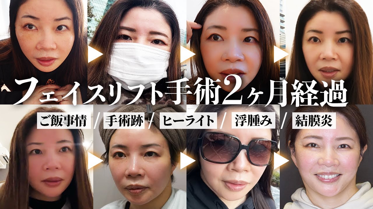 【フェイスリフトダウンタイム密着②】アングルフェイスリフト手術1週間後〜2ヶ月の経過をお見せします。