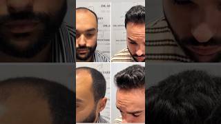 Greffe de cheveux Norwood 4 à 27 ans : résultat à 8 mois