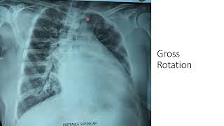 Chest X Ray Lesson 11: Identifying Rotation in Chest X Ray