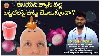 ఆనియన్ జ్యూస్ వల్ల బట్టతలపై జుట్టు మొలుస్తుందా | Does Onion Juice increase Hair on Bald Head