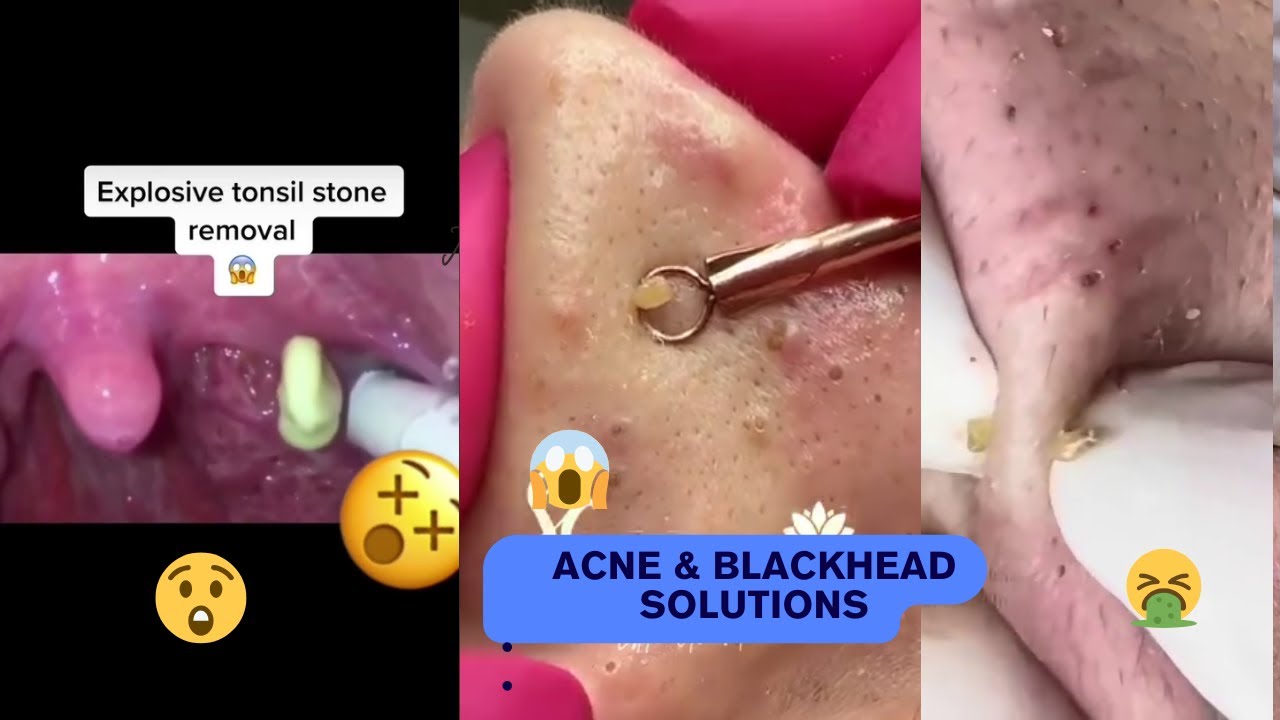 Most Satisfying Pimple Popping, Cyst Removal, Acne & Blackhead