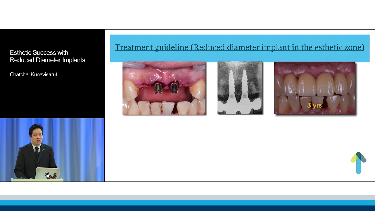 Esthetic Success with Reduced Diameter Implants | Chatchai Kunavisarut
