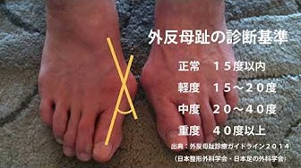 外反母趾の方の多くが 足だった 2 外反母趾をまなぶ講座 Youtube