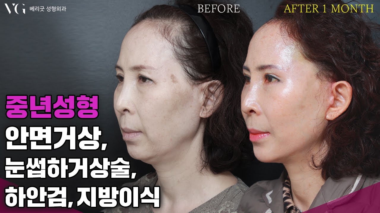 [Phòng khám thẩm mỹ Berrygood] Bác sĩ Lim Young-min
[Thẩm mỹ trung niên] Các mẹ muốn thoát khỏi nỗi lo về làn da chảy xệ và nếp nhăn ❗ Nâng cao sự tự tin với làn da săn chắc, trẻ trung 💗 Tâm hồn cũng sẽ trẻ hóa theo nhé~
Căng da mặt, nâng cung mày, phẫu thuật mí mắt dưới