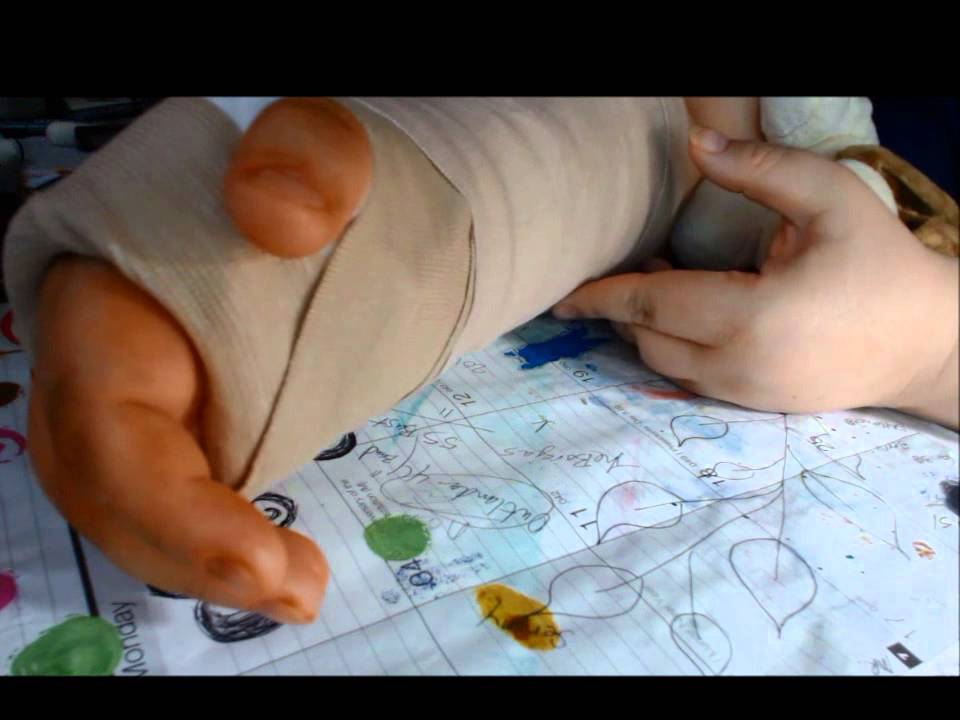 Surgery for broken wrist