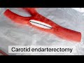 Playdough surgery  carotid endarterectomy
