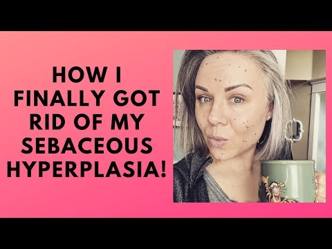 Finally getting rid of my Sebaceous Hyperplasia - Collab with PennSmithSkincare!