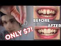 How I Closed The Gap In My Teeth In LESS THAN 1 WEEK!? (DIY Budget Braces / Gap Bands)