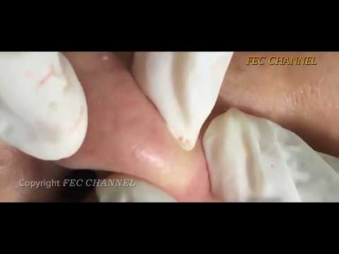 Blackheads Extracting Acne ,Face Pimples, Cystic Acne  And Treatment For Relaxing Part 