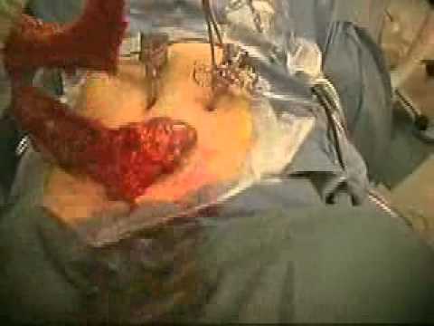 Colon Resection - Removal Entire Colon