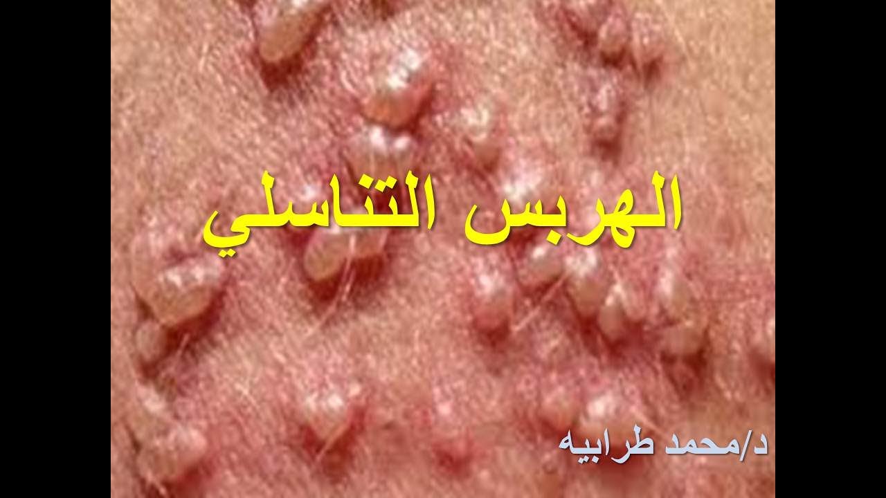 أسباب و علاج الهربس التناسلي. #دكتور_محمد_طرابيه