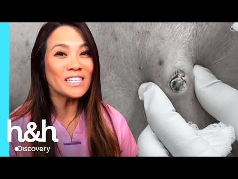 La doctora Lee saca un punto negro ENORME | Dra. Sandra Lee: Especialista en piel | Discovery H&H