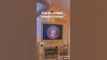Как выглядят камни в почке? Смотрим через эндоскоп.
