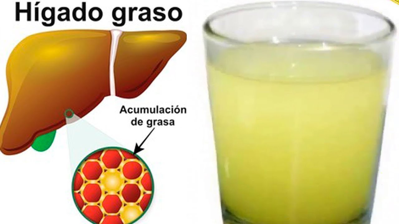Como Limpiar Tu Higado Graso Y Dejarlo Como Nuevo www.youtube.com
