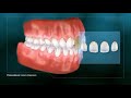 Dental Veneers Procedure Explained: How to Get a Perfect Smile Makeover