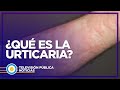 Qué es y cómo tratar la urticaria