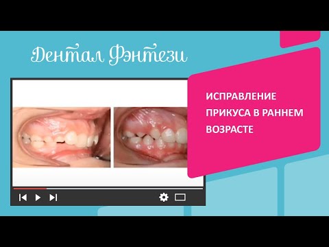 😬 Ортодонтия у детей: исправление прикуса в раннем возрасте