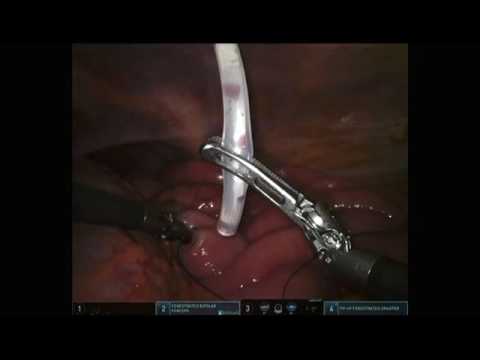 robotic feeding jejunostomuy tube