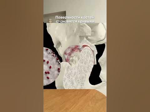 Болезни тазобедренного сустава у женщин лечение. Дисплазия тазобедренного сустава: симптомы, диагностика и лечение. Дисплазия тазобедренных суставов: лечение, причины, симптомы Болезни тазобедренного сустава: симптомы, лечение, отзывы (фото)